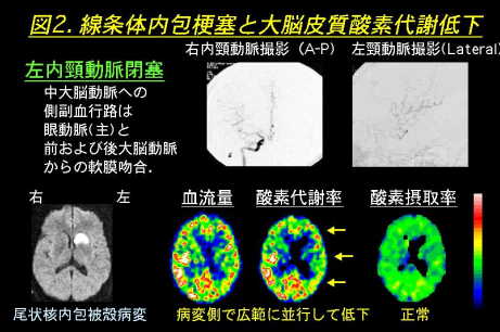線条体内包梗塞と大脳皮質酸素代謝低下の図