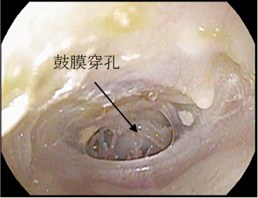 手術前（右耳、中心性穿孔）
軽度難聴(31.3dB)

