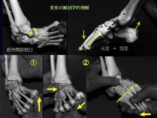 変形の解剖学的理解