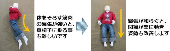 痙縮の全身