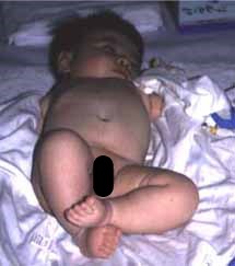 先天性股関節脱臼の赤ちゃん写真1