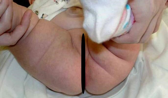 先天性股関節脱臼の赤ちゃん写真3
