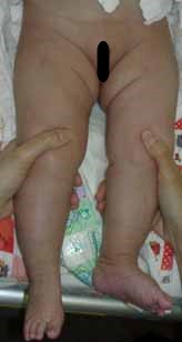 先天性股関節脱臼の赤ちゃん写真5