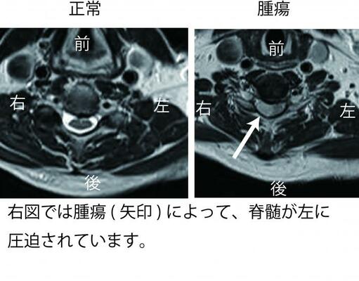 脊髄腫瘍