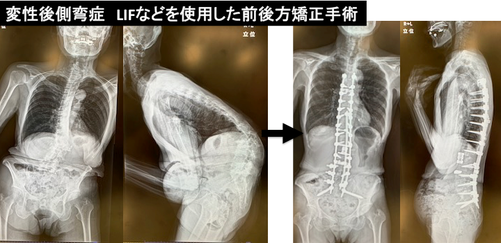 変性後側弯症LIFなどを使用した前後方矯正手術