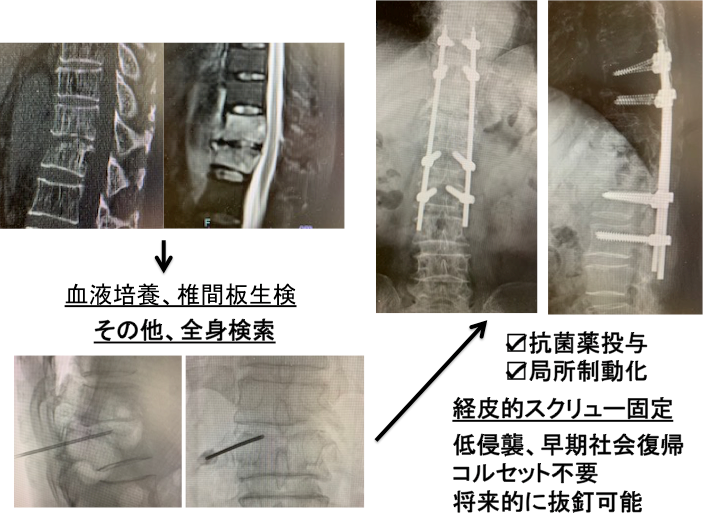 化膿性脊椎炎に対する治療の写真1