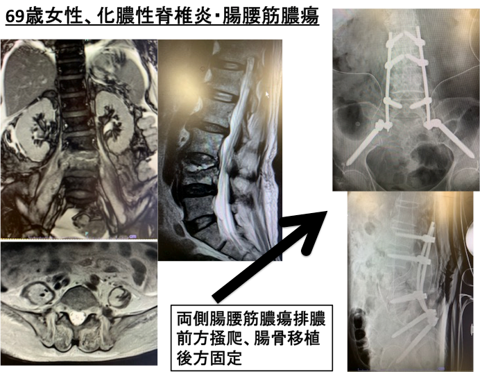 化膿性脊椎炎に対する治療の写真2