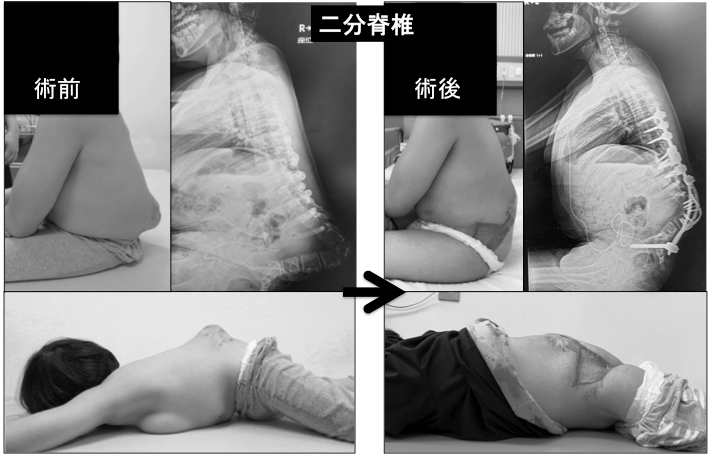 二分脊椎