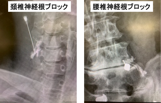 神経根ブロック