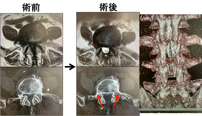 腰椎椎弓切除