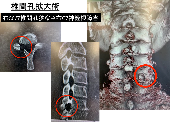 椎間孔拡大