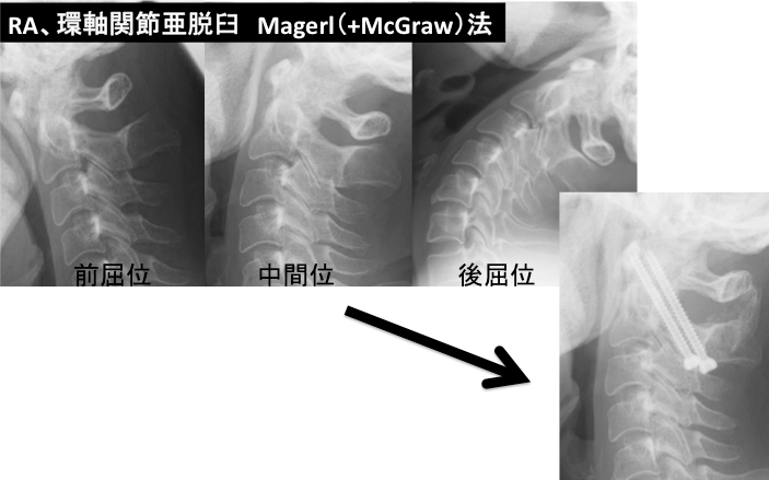 頚椎固定術2
