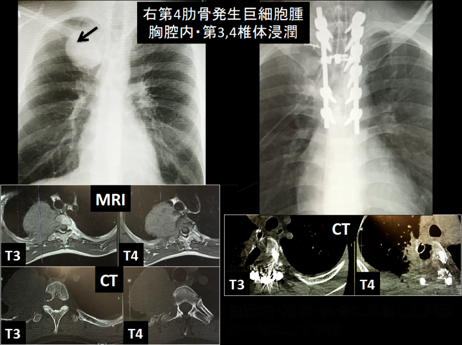 原発性・転移性脊椎腫瘍、脊髄腫瘍に対する手術1