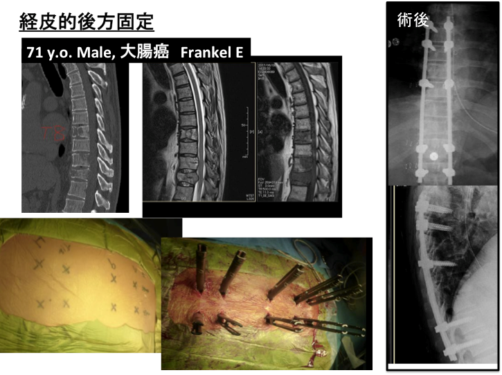 原発性・転移性脊椎腫瘍、脊髄腫瘍に対する手術2