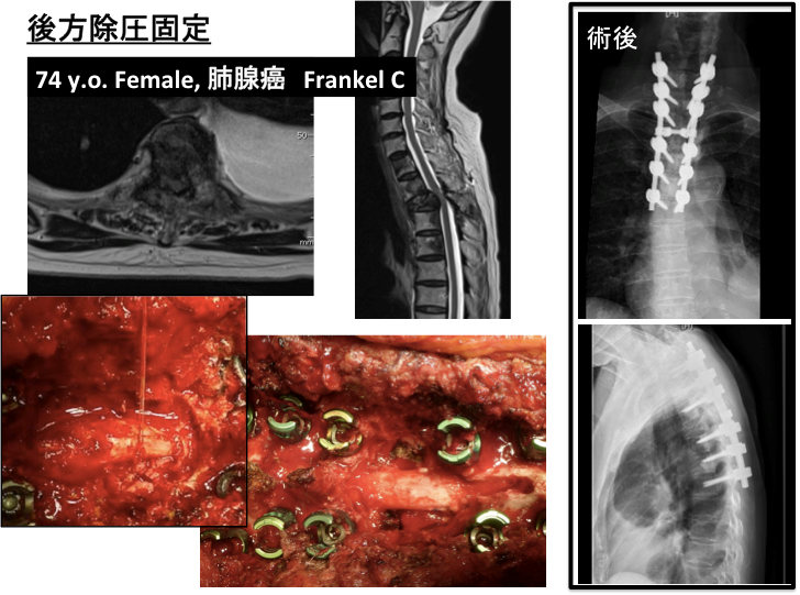 原発性・転移性脊椎腫瘍、脊髄腫瘍に対する手術3