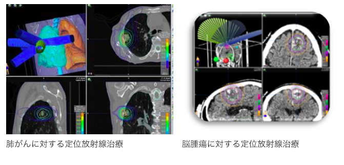 定位放射線治療