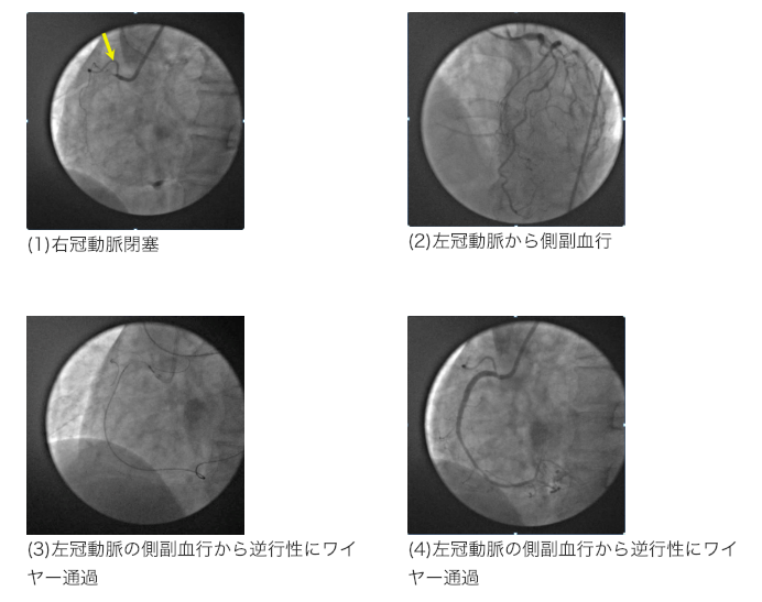 b.慢性完全閉塞病変