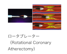 ロータブレーター(Rotational Coronary Atherectomy)