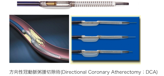 方向性冠動脈粥腫切除術(Directional Coronary Atherectomy;DCA)