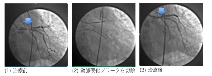 動脈硬化プラーク