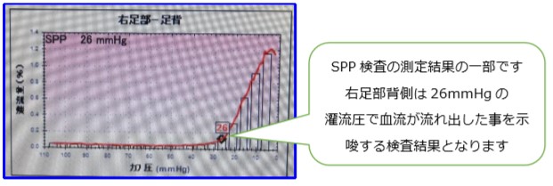 SPP検査(皮膚灌流圧検査)