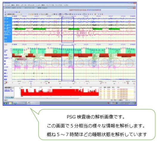 PSG検査後の解析画像です