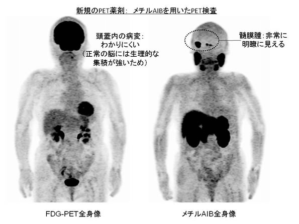 新規のPET薬剤：メチルAIBを用いたPET検査